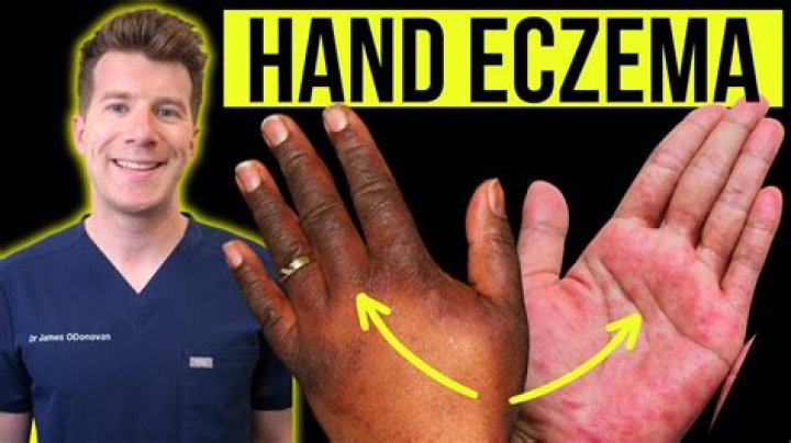 Is working hands good for eczema?