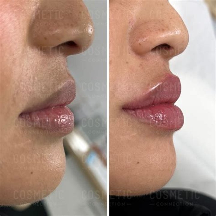 Should I get 1ml or 2ml lip filler?
