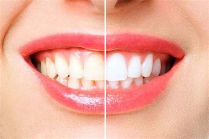 Should teeth be completely white?