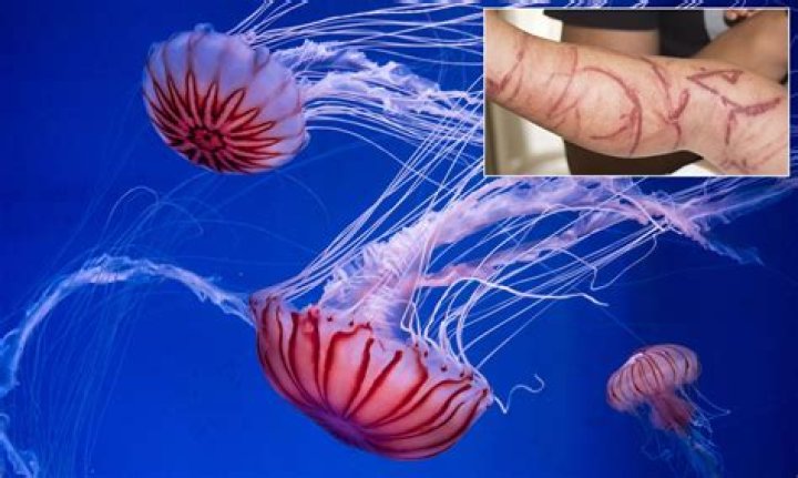Should you pee on a jellyfish sting?