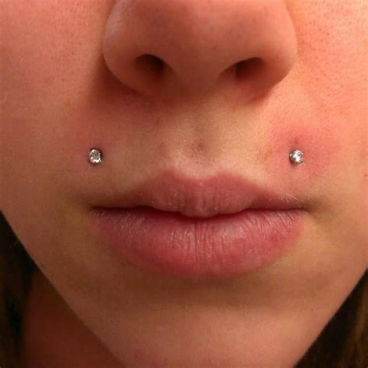 What are angel bites?