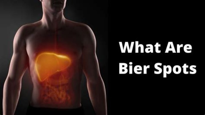 What are Bier spots?