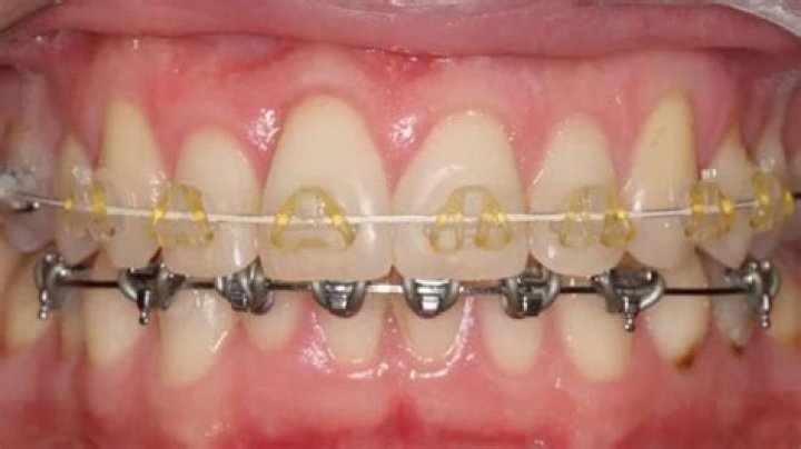 What are fast braces?