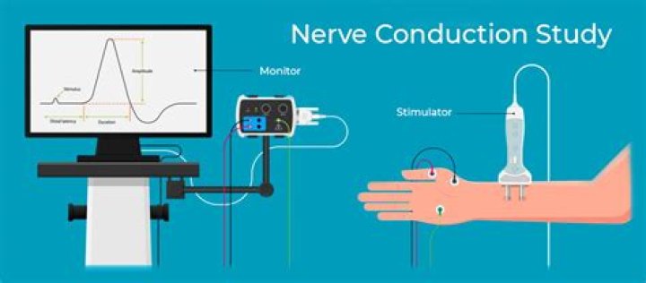 What are the side effects of a nerve conduction test?