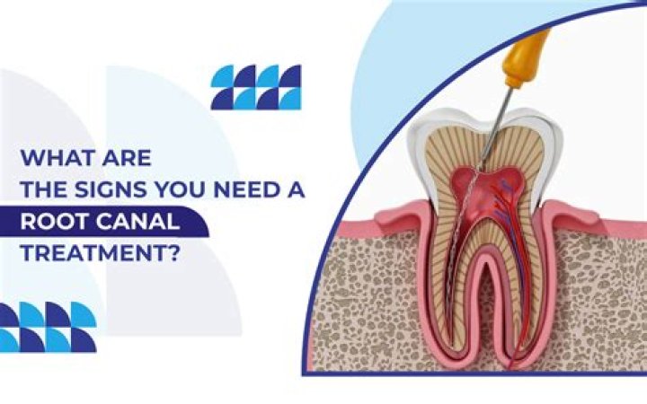 What are the signs you need a root canal?