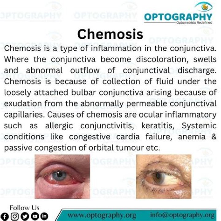 What are the symptoms of chemosis?