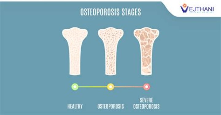 What are the three stages of osteoporosis?