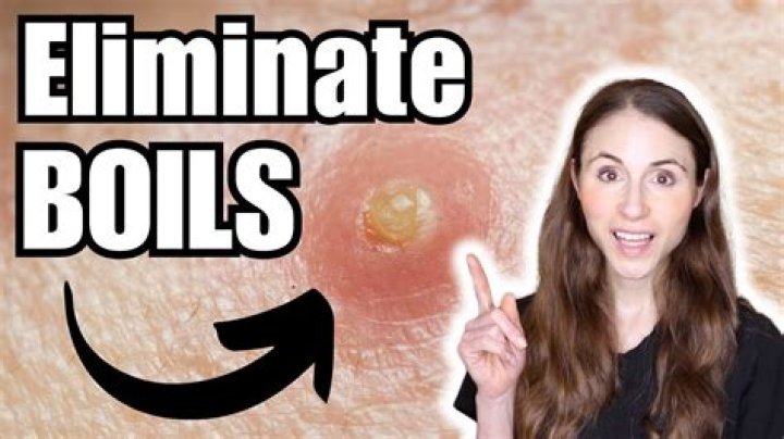 What can trigger boils?