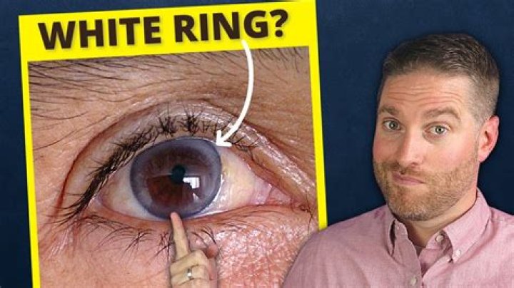 What does a GREY ring around the eye mean?
