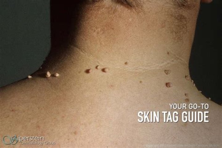 What does a large skin tag look like?