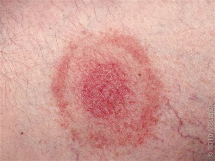 What does a normal tick bite look like?