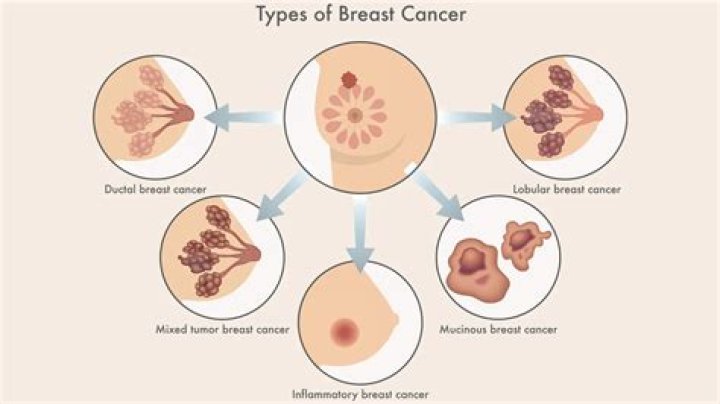 What does ice do to your breast?