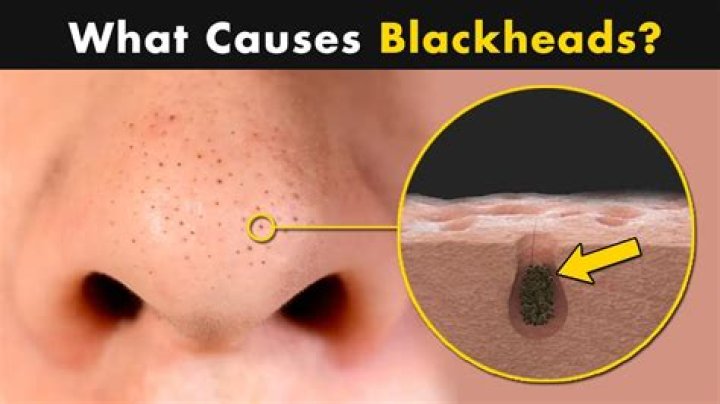 What does it mean when you have a blackhead in your ear?