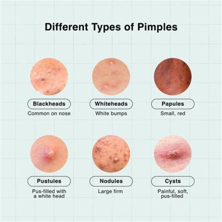 What does pimple pus taste like?