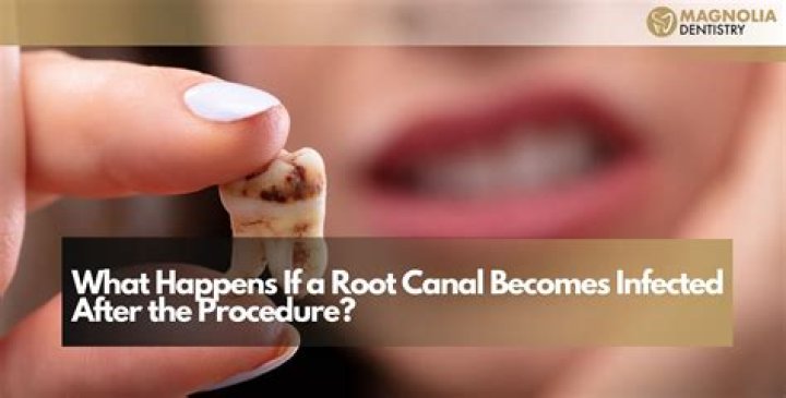 What happens when a root canal gets infected?