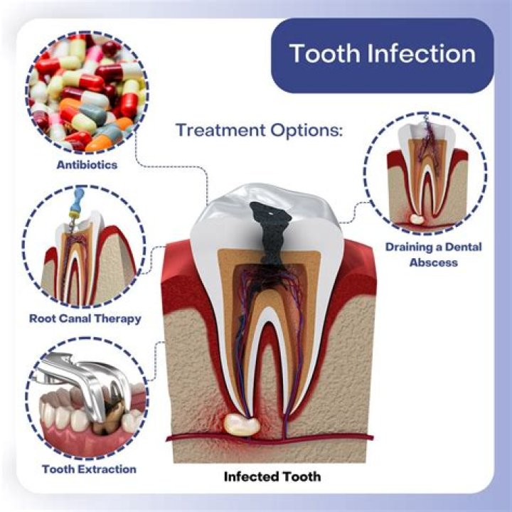 What happens when a tooth infection gets in your bloodstream?