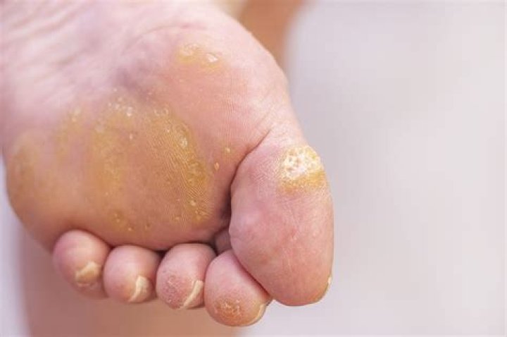 What HPV causes warts on feet?