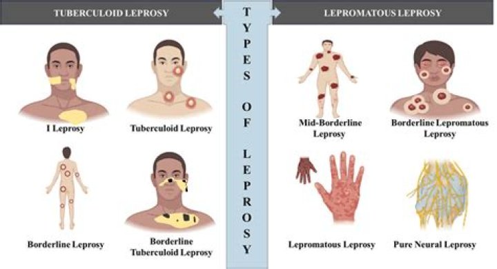 What is borderline leprosy?