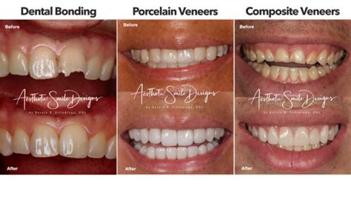 What is cheaper composite bonding or veneers?