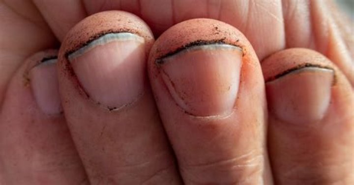 What is the gunk under your toenails?