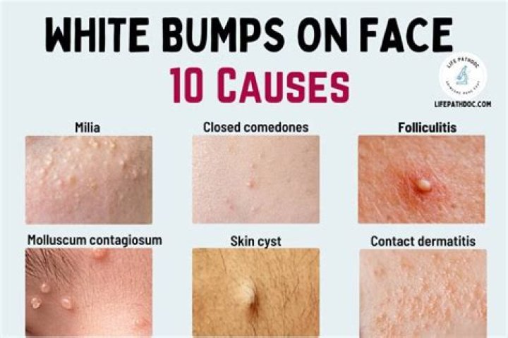 What is the hard white stuff in a pimple Reddit?