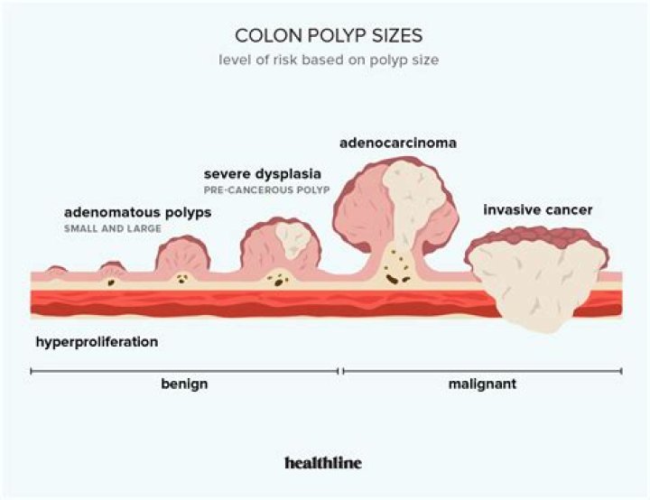 What is the largest size polyp that can be removed during a colonoscopy?