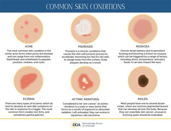 What is the most common skin type?