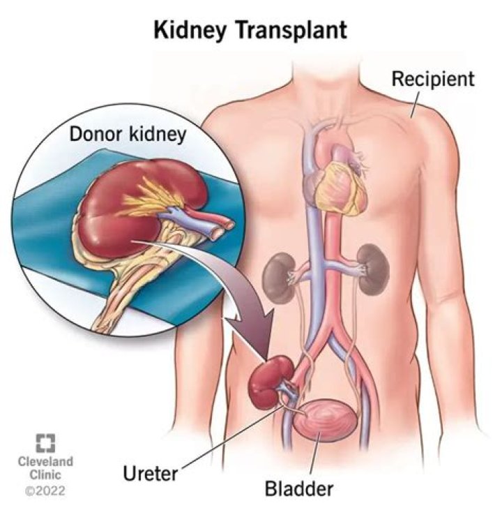What is the oldest age for kidney transplant?