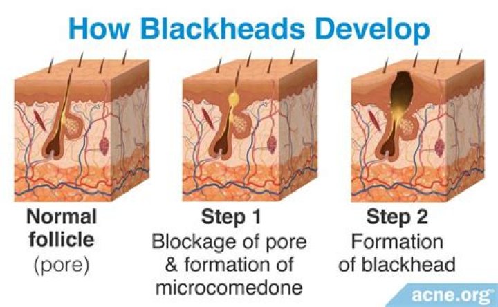 What is the seed of a blackhead?