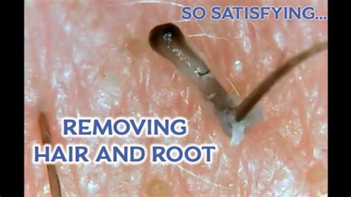 What is the stuff at the end of a plucked hair?