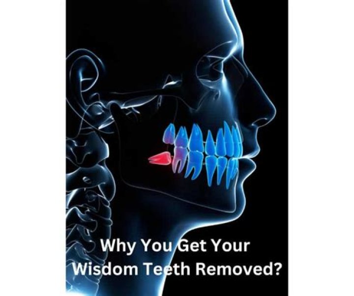 What is the youngest age you can get your wisdom teeth removed?