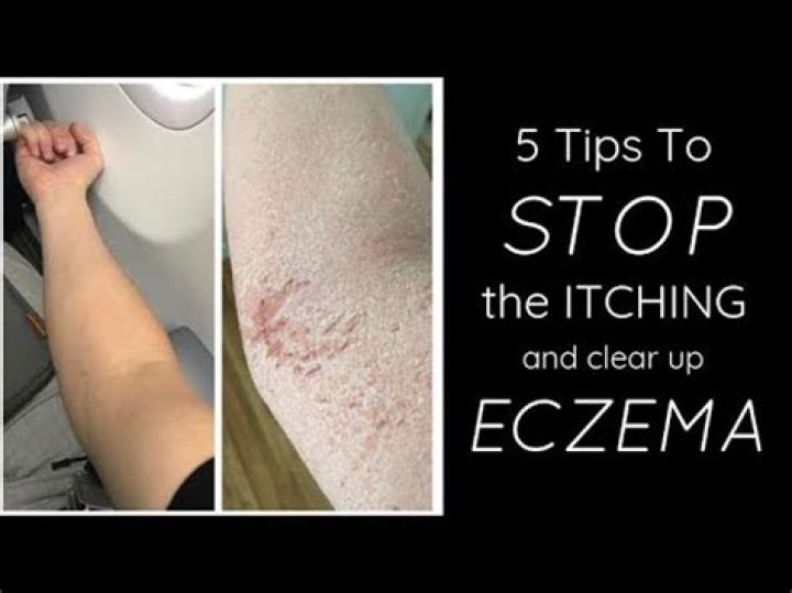 What stops eczema itching?
