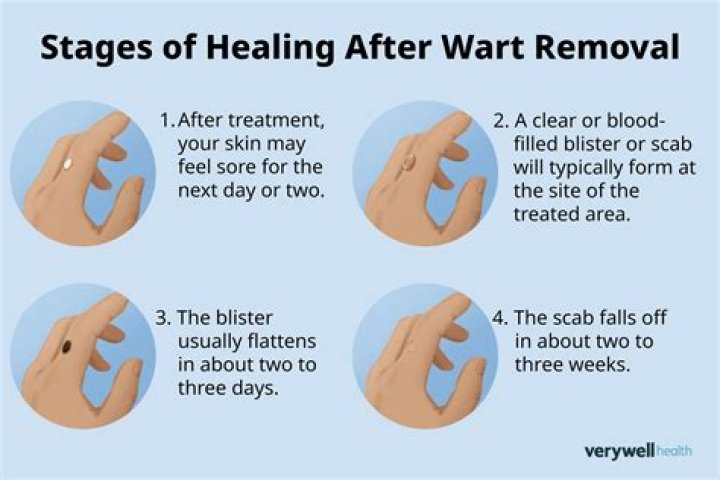What to do after wart falls off?