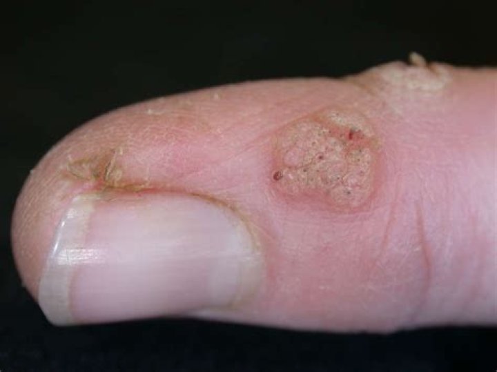 What virus causes common warts?