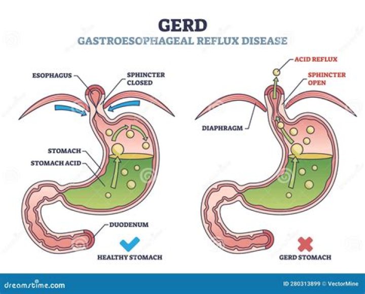 What will happen if acid reflux is not treated?