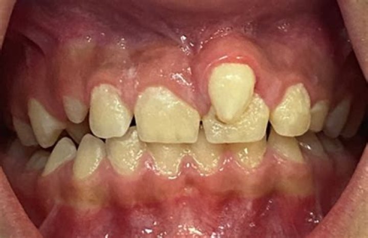 What you mean by supernumerary?