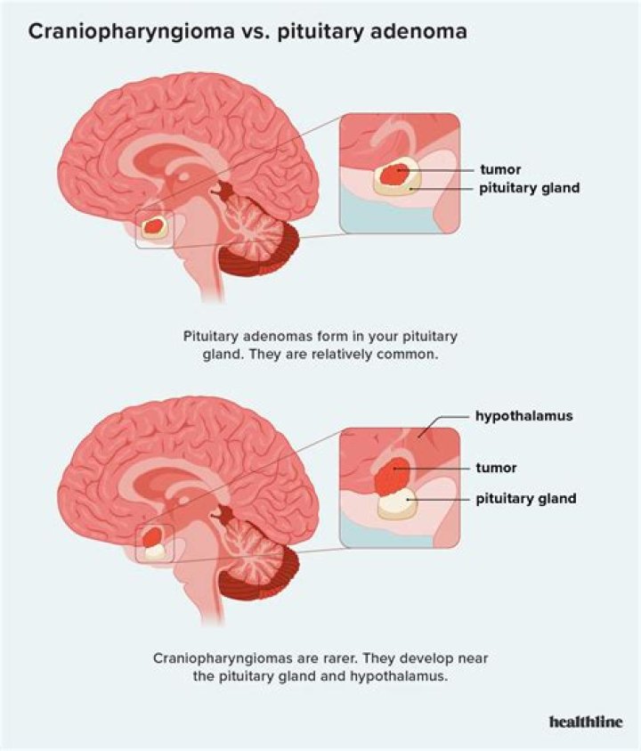 Which of the following are common early signs of a pituitary adenoma?