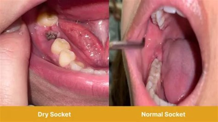 Which teeth are more prone to dry socket?