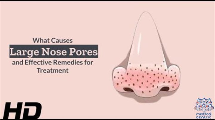 Why are my nose pores so big?