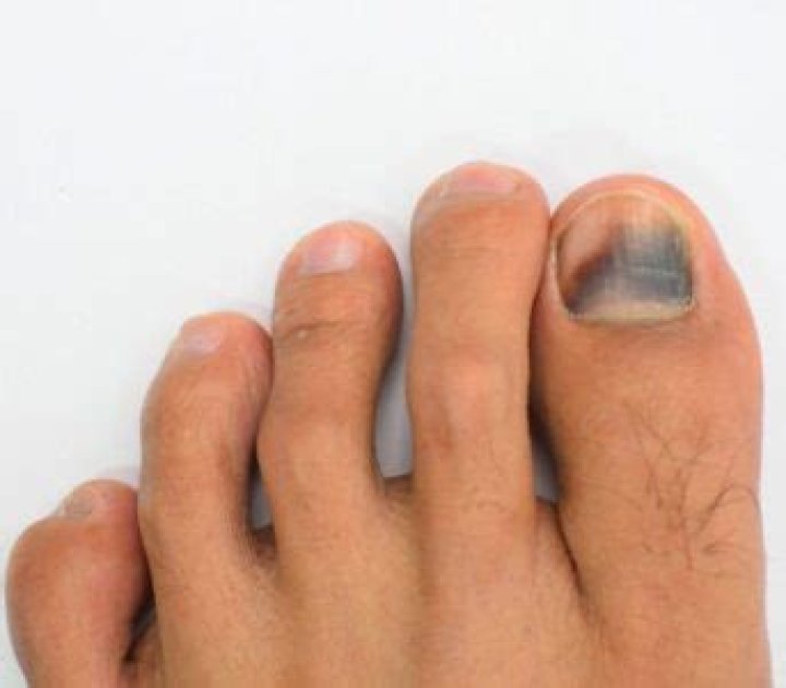 Why are my toenails discolored?