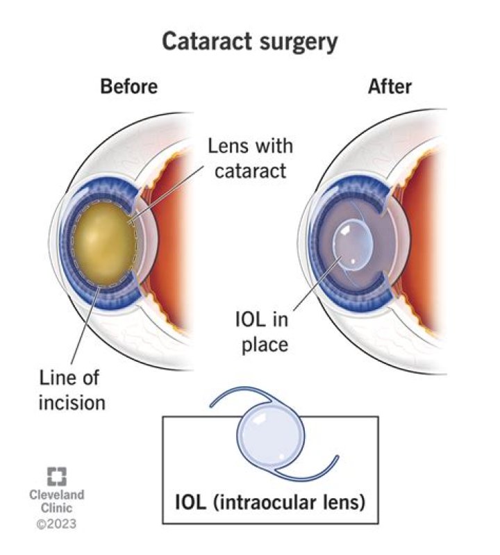 Why can't you bend at the waist after cataract surgery?