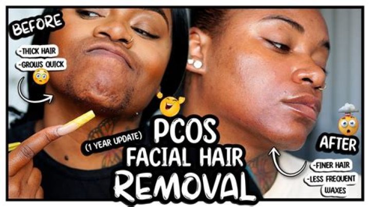 Why do I have facial hair at 13?