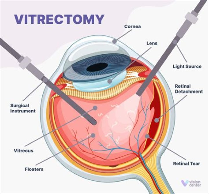 Why do I have poor vision after vitrectomy?