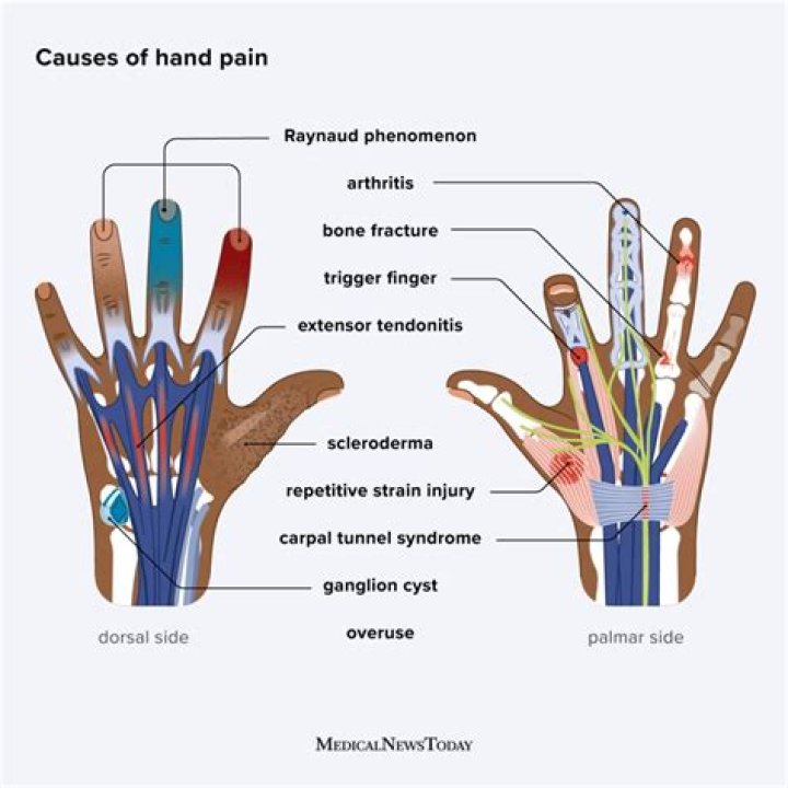 Why do my hands hurt with fibromyalgia?