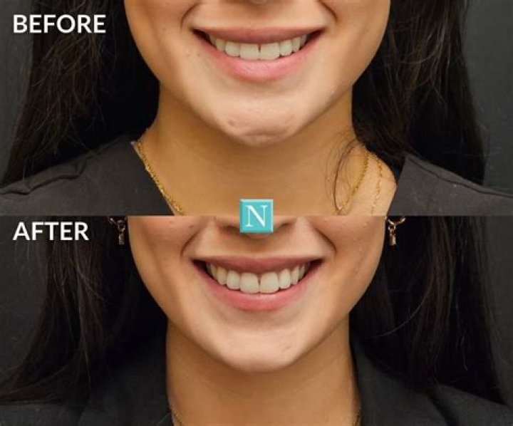 Why do some of us have dimples?