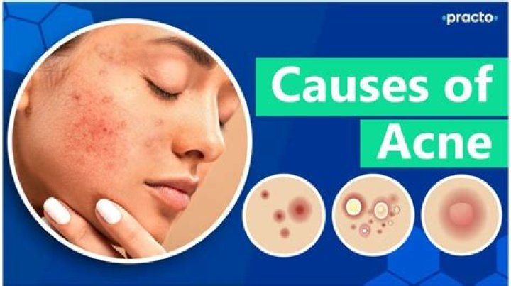 Why do some pimples shoot out?