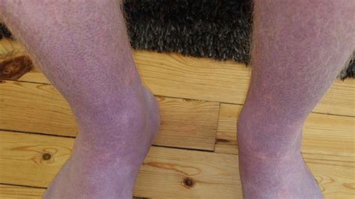 Why does my broken foot turn purple when I stand up?