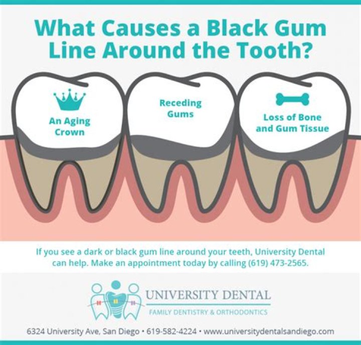 Why is my tooth black at the gum line?