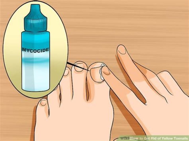 Will vinegar get rid of yellow toenails?